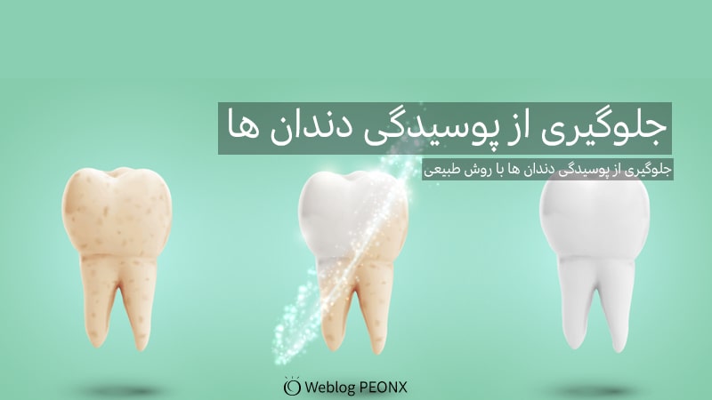 جلوگیری از پوسیدگی دندان با روش کم هزینه