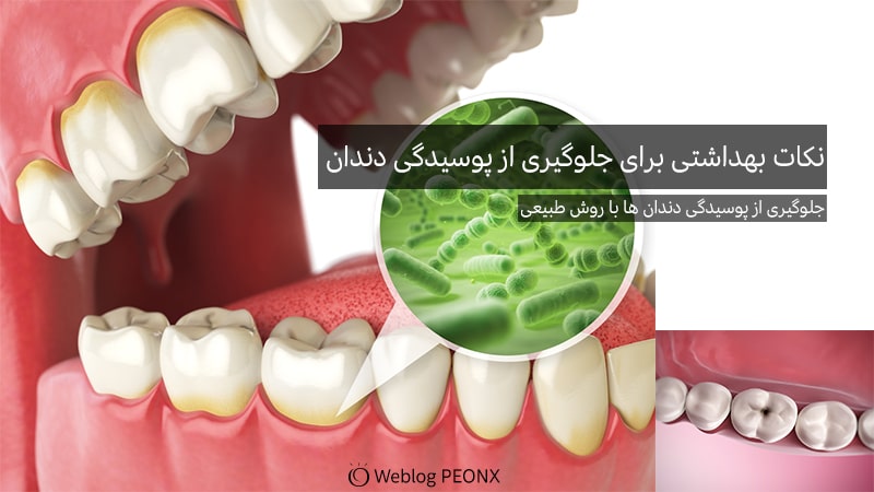 راه های جلوگیری از پوسیدگی دندان-