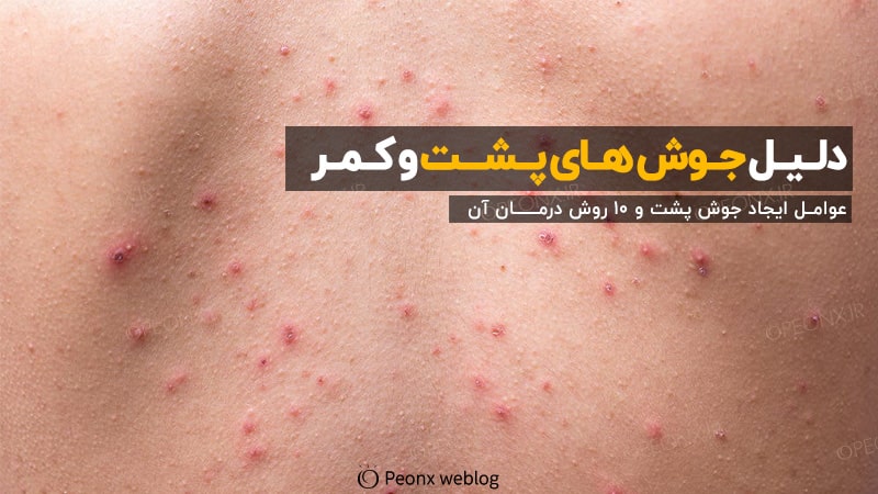 چرا پشت کمر جوش میزند؟