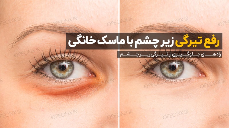 رفع تیرگی زیر چشم با ماسک خانگی