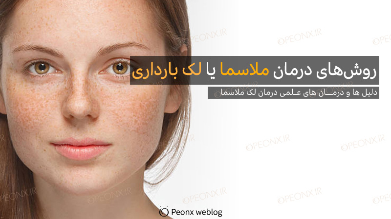 روشهای درمان ملاسما یا لک بارداری