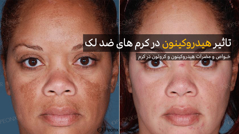 ضرر های هیدروکینون در کرم های ضد لک و ضد جوش