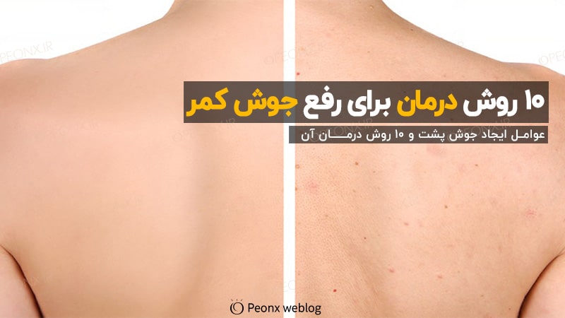 10 روش درمان جوش های کمر