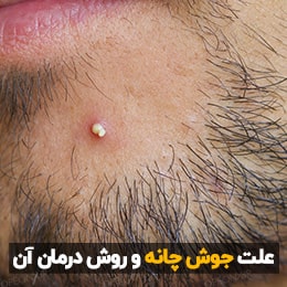 علت جوش روی چانه چیست؟