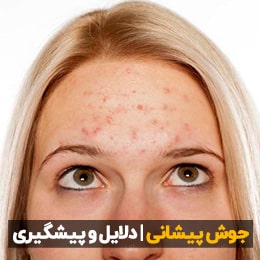 دلایل جوش پیشانی