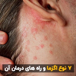 اگزما و روش‌های پیشگیری و درمان اگزما