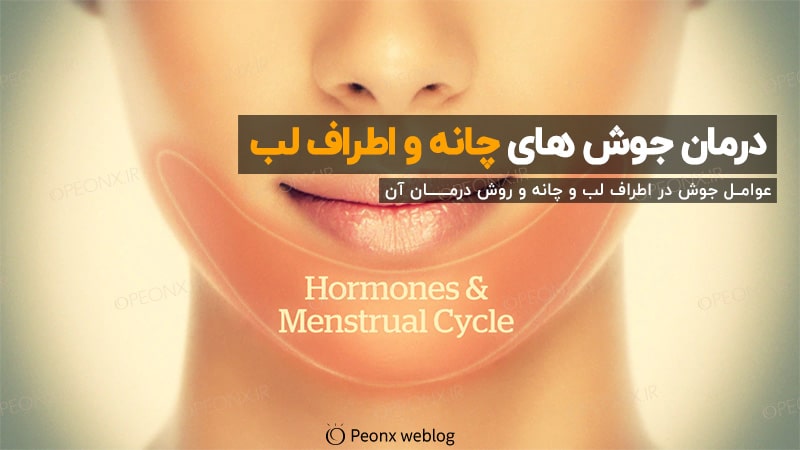 جوش چانه، اطراف لب و خط فک