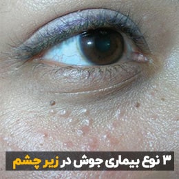 علت جوش اطراف چشم چیست؟