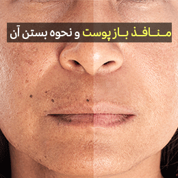 راه های درمان منافذ باز پوست