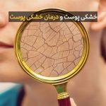 خشکی پوست و نحوه رفع خشکی پوست