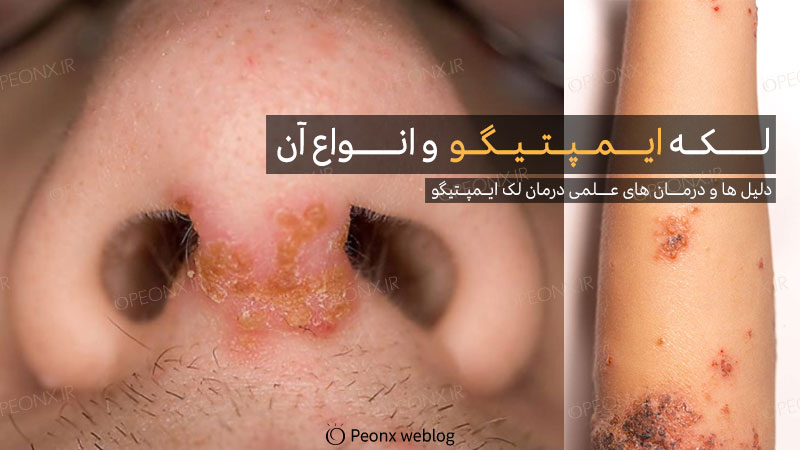 ایمپتیگو و انواع آن