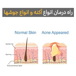 انواع آکنه و روش‌های پیشگیری و رفع آن
