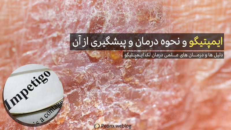 ایمپتیگو و نحوه درمان و پیشگیری از آن