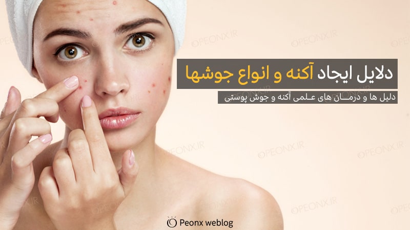 دلایل ایجاد آکنه