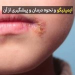 ایمپتیگو و نحوه درمان و پیشگیری از آن