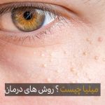 روشهای درمان میلیا و پیشگیری از آن
