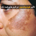ضرر های هیدروکینون در کرم های ضد لک و ضد جوش