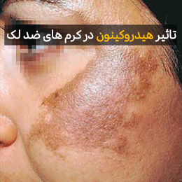 ضرر های هیدروکینون در کرم های ضد لک و ضد جوش