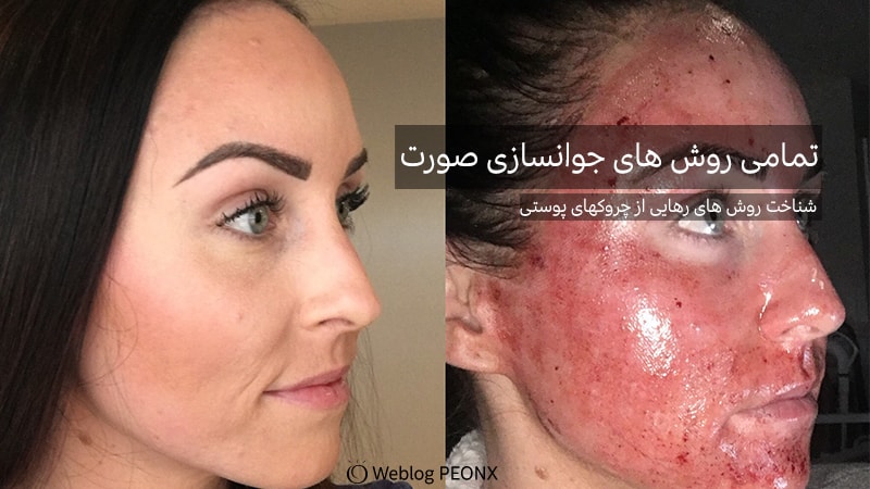 ميكرونيدلينگ برای چروک صورت ميكرونيدلينگ برای چروک صورت