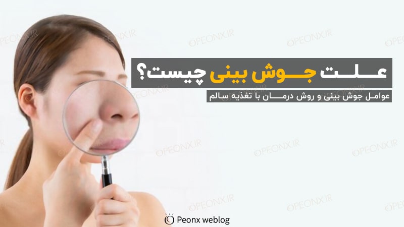 علت جوش بینی چیست؟