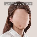 رابطه جوش با تغذیه