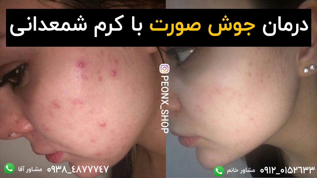 درمان جوش صورت با کرم دهکاره