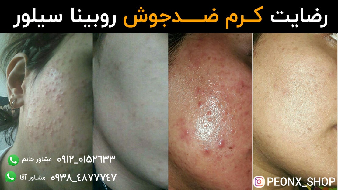 درمان جوش صورت با کرم روبینا