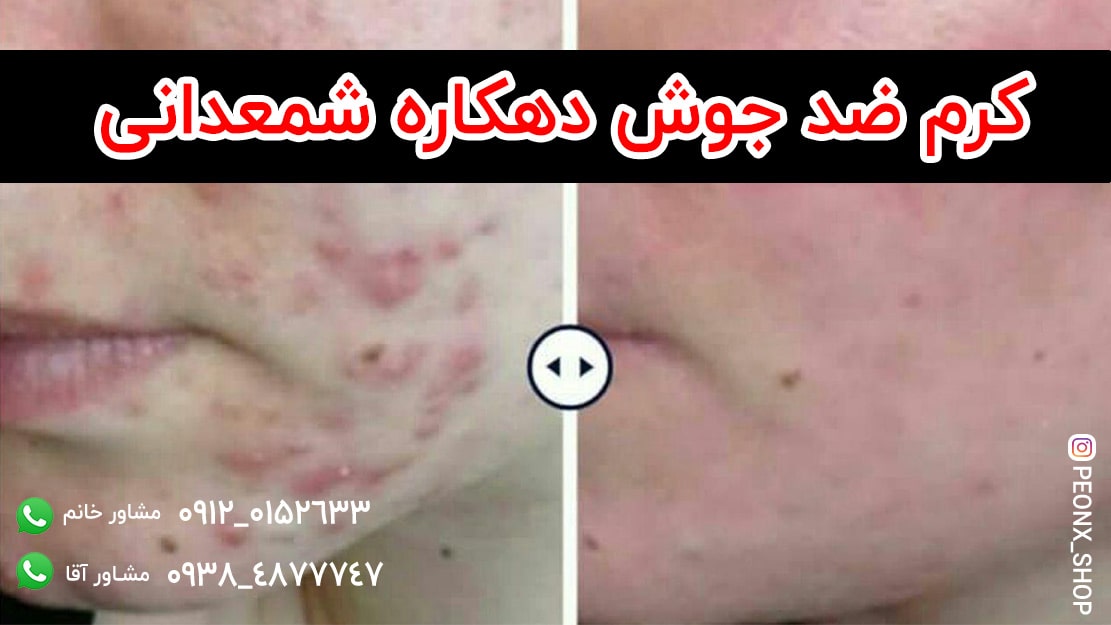 درمان جوش صورت با کرم شمعدانی دهکاره