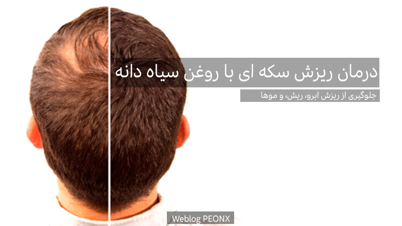 درمان ریزش مو به ویژه ریزش سکه ای