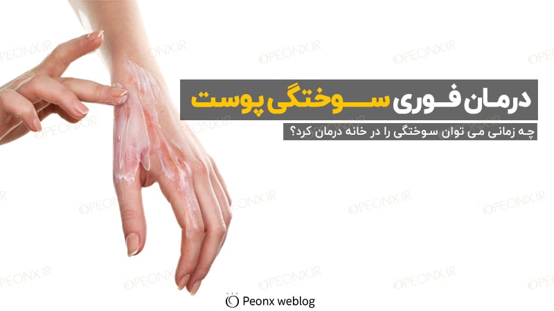 درمان فوری سوختگی پوست