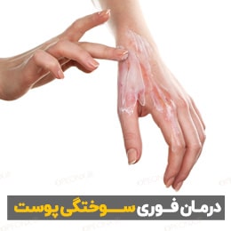 درمان فوری سوختگی پوست1