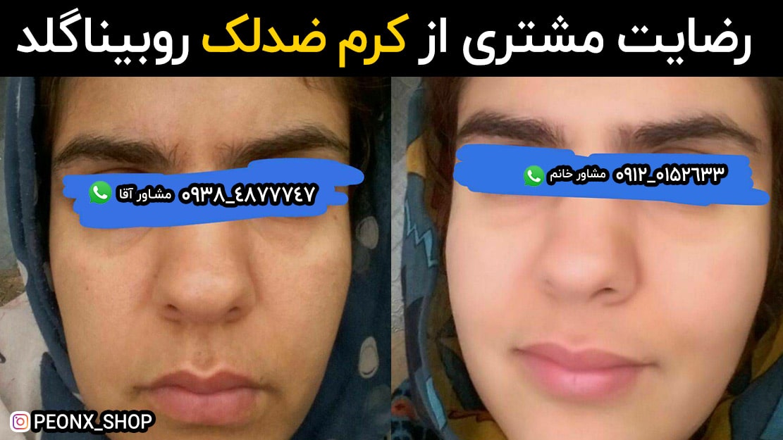 درمان لک صورت با کرم روبینا گلد