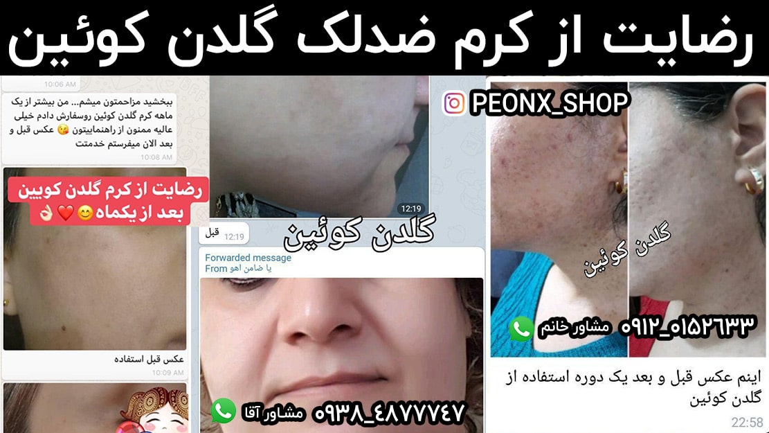 درمان لک و جوش با کرم گلدن کوئین