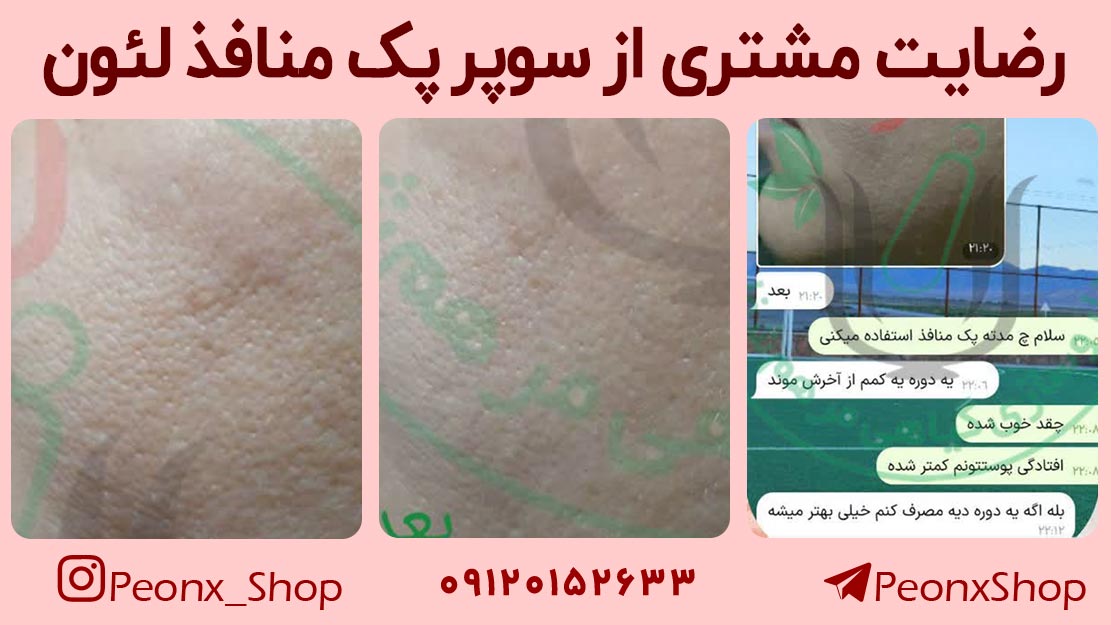 درمان منافذ باز و پوست پرتقالی