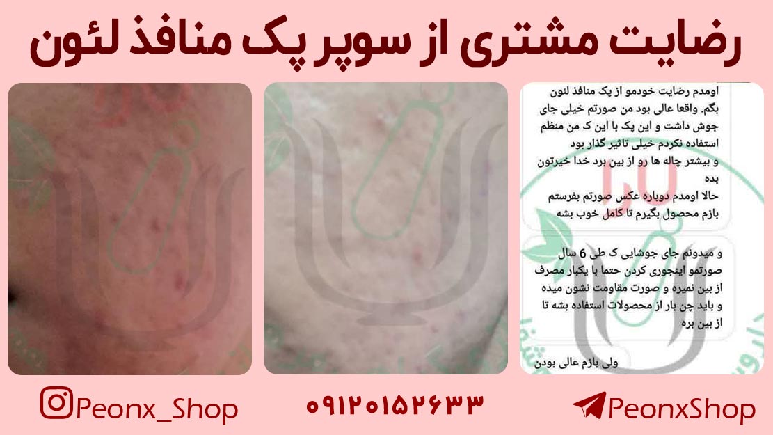 درمان پوست پرتقالی در منزل