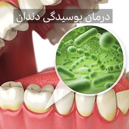 درمان پوسیدگی دندان