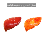 درمان کبد چرب با 10 دمنوش گیاهی