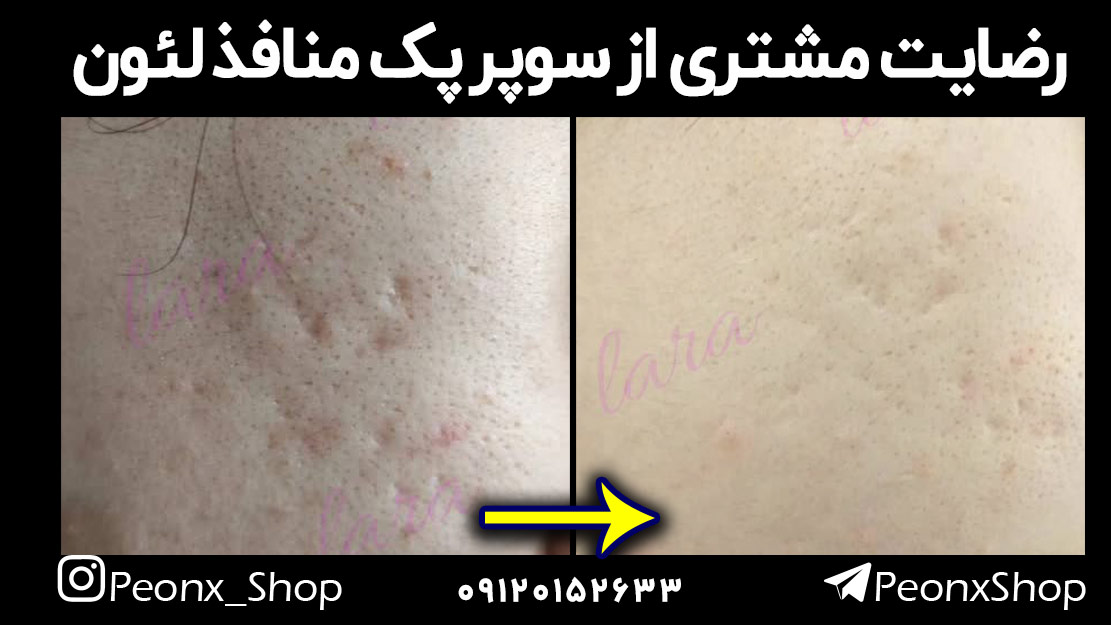 رضایت مشتری از سوپر پک منافذ لئون