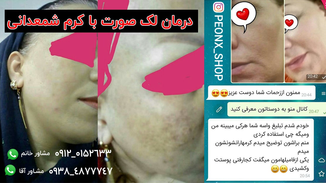 رضایت مشتری از مصرف کرم ضدلک هشتکاره شمعدانی