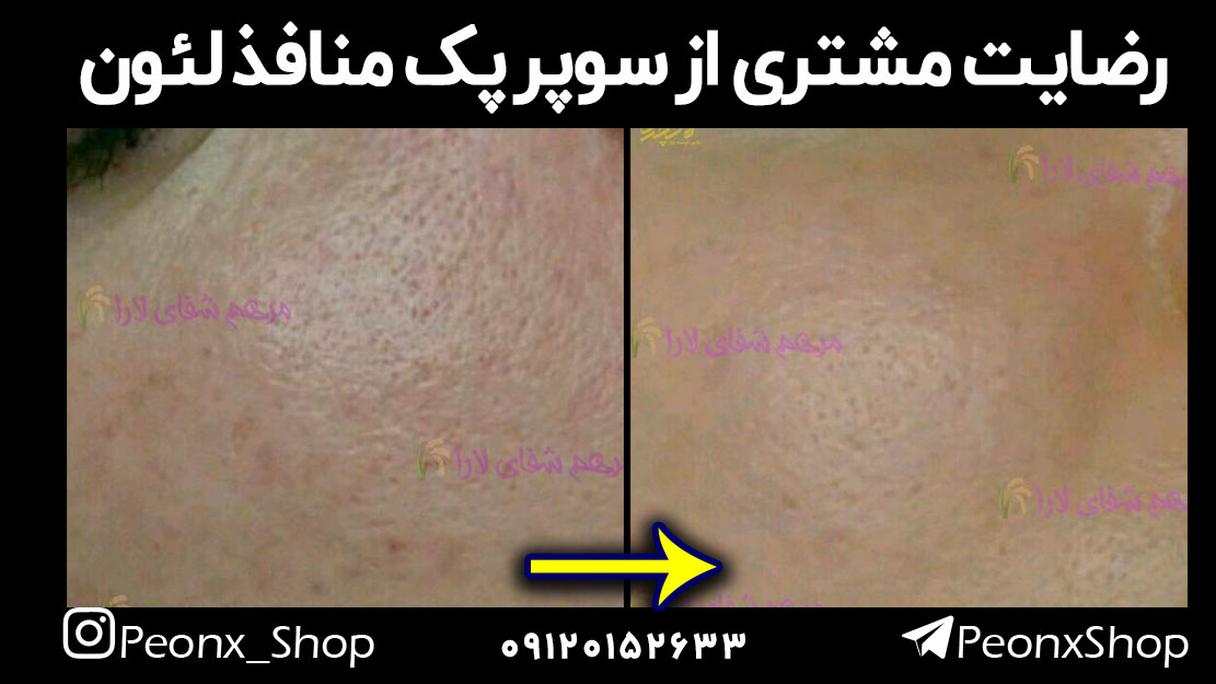 خرید پک منافذ لئون