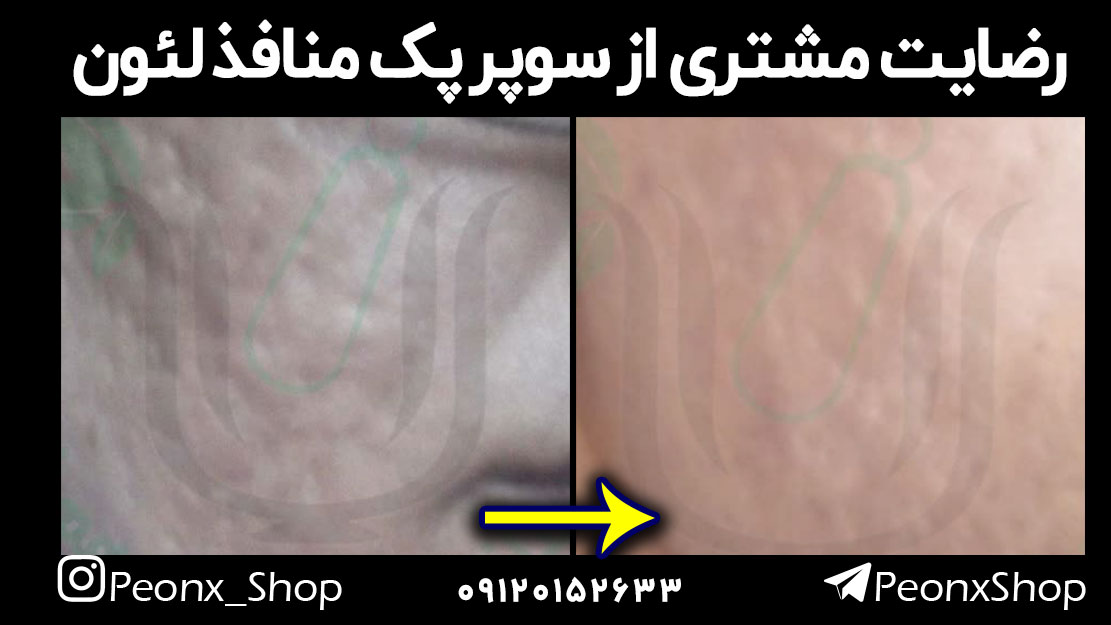 رفع چاله‌های پوستی با سوپر پک منافذ لئون