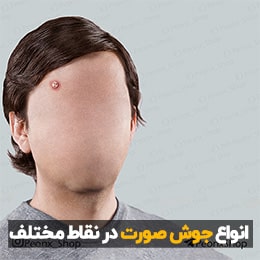 شناخت انواع جوش صورت