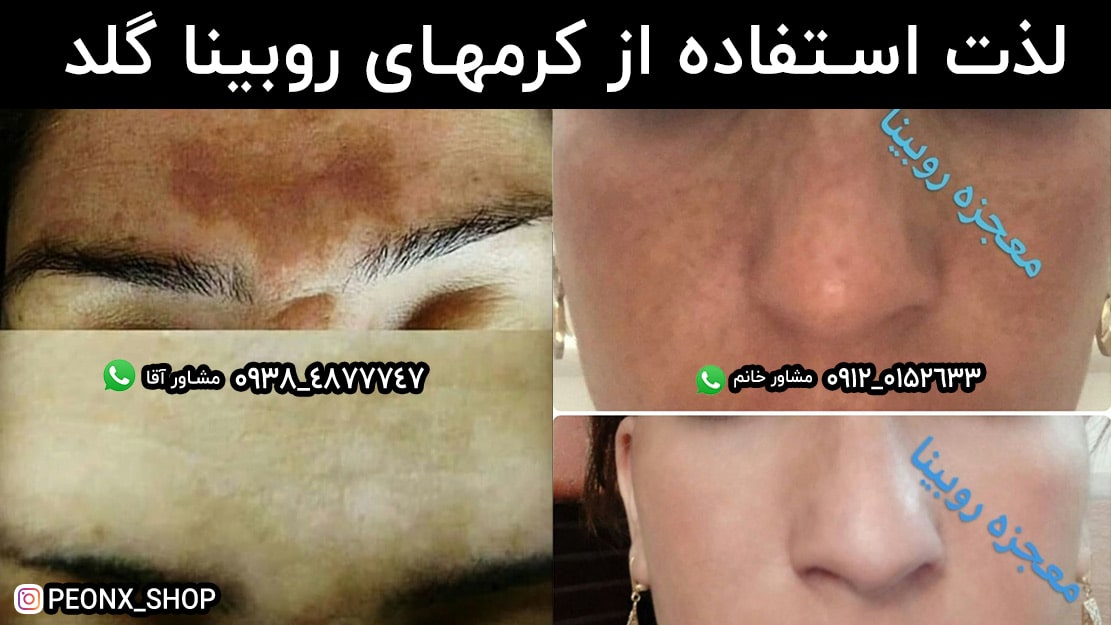 درمان لک صورت با کرم روبینا گلد