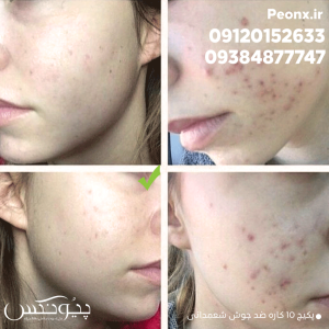رضایت مشتری از کرم ضد جوش شمعدانی