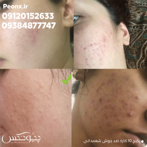 رضایت مشتری از کرم ضد جوش شمعدانی