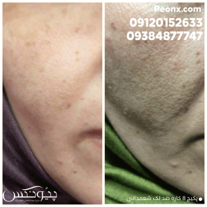 رضایت مشتری از کرم ضد لک شمعدانی
