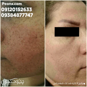 رضایت مشتری از کرم ضد لک شمعدانی