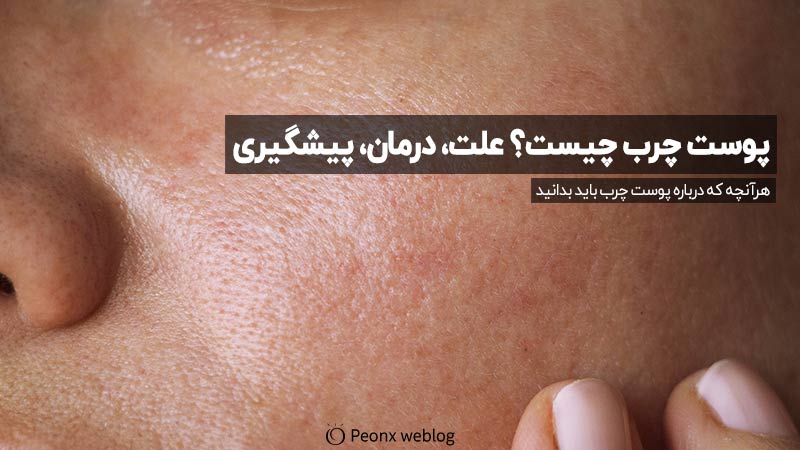 هرآنچه که درباره پوست چرب باید بدانید پوست چرب چیست؟ علت، درمان، پیشگیری