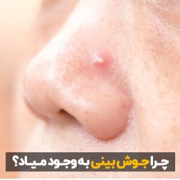 علت جوش بینی چیست؟