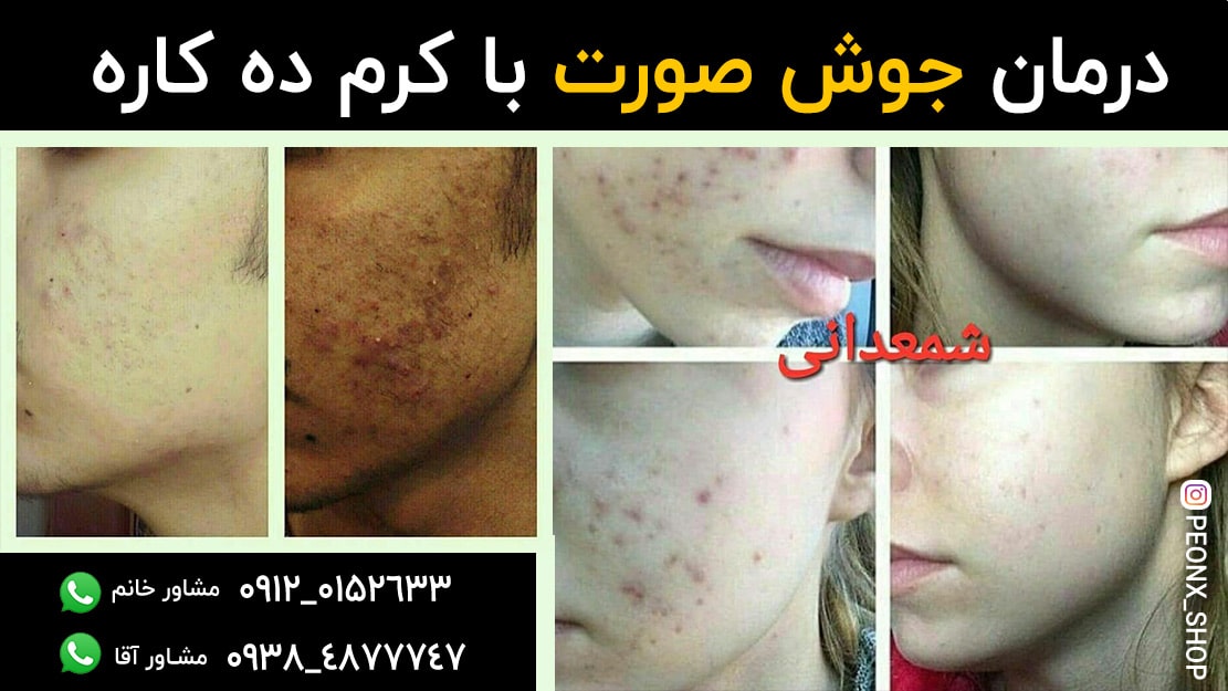 کرم ضدجوش صورت شمعدانی دهکاره